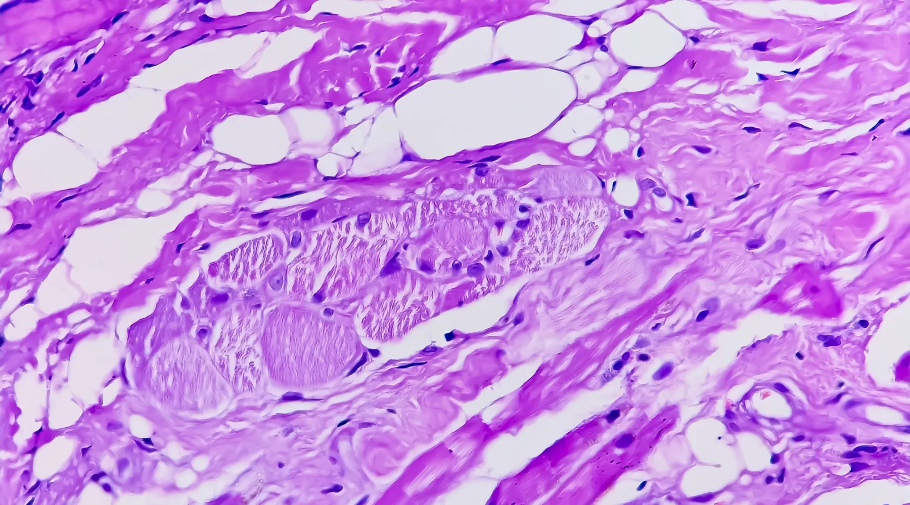 Photomicrograph showing tongue squamous cell carcinoma Grade II